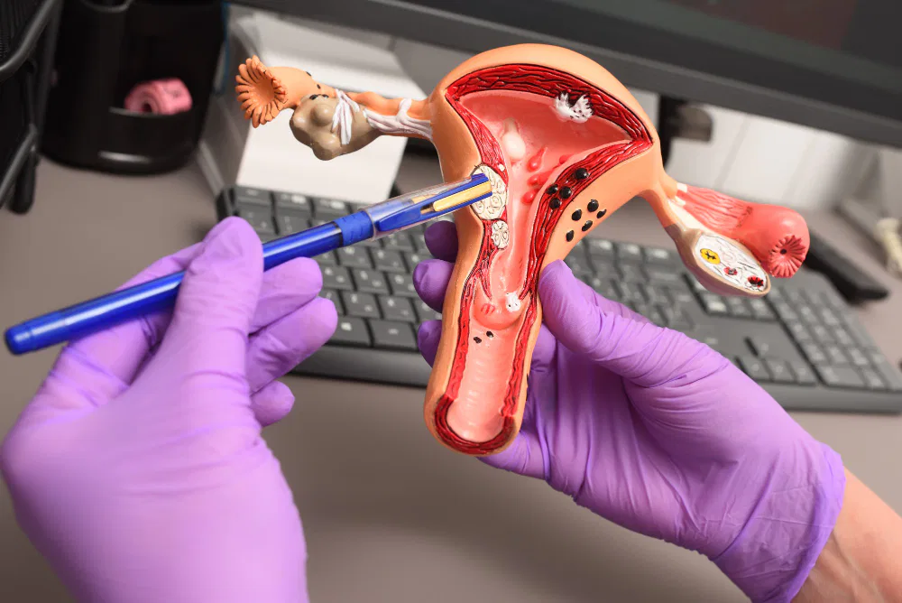 Who Is a Good Candidate for Uterine Fibroid Embolization?
