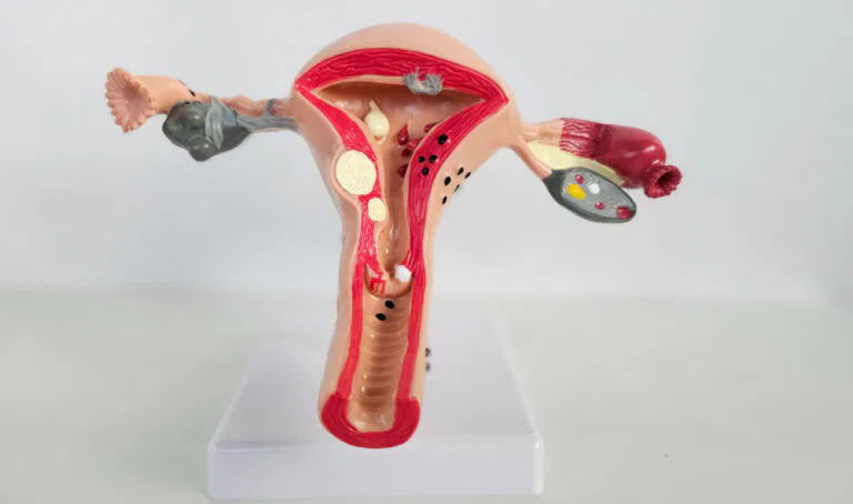 Long-Term Side Effects of Fibroid Embolization: What Women Need to Know