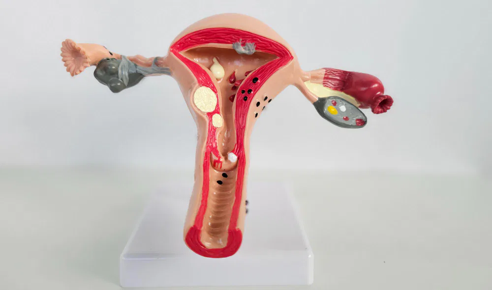 Long-Term Side Effects of Fibroid Embolization: What Women Need to Know