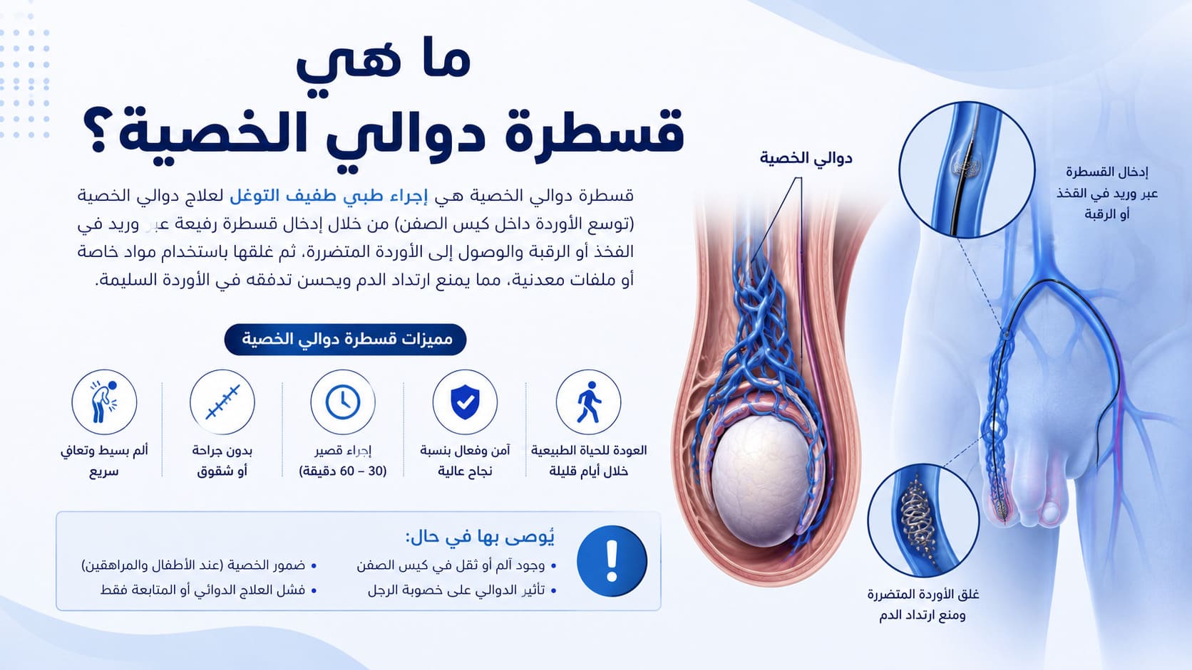 ما هي قسطرة دوالي الخصية؟
